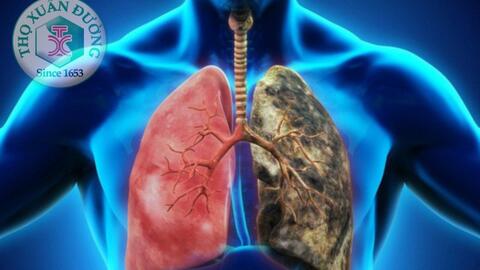 Nguyên nhân gây ung thư phế quản phổi nguyên phát