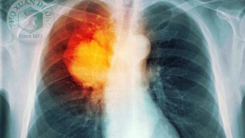 Triệu chứng bệnh ung thư phế quản phổi nguyên phát