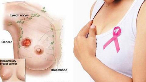 Các giai đoạn của ung thư vú 