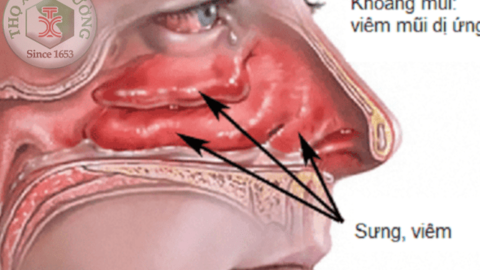 Viêm mũi dị ứng và viêm mũi thông thường khác nhau ở đâu?
