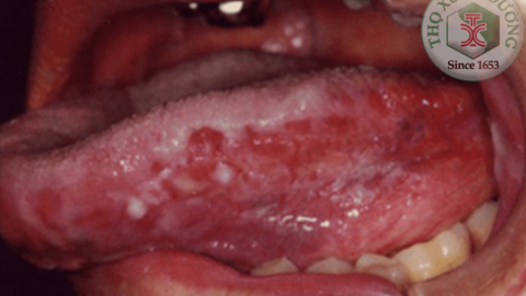 Phát hiện ung thư lưỡi sớm bởi dấu hiệu đơn giản
