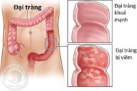 <a href="/benh-pho-bien/benh-tieu-hoa/dai-truc-trang" title="Đại trực tràng" rel="dofollow">Đại trực tràng</a>
