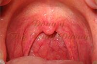 <a href="/benh-pho-bien/ho-hap/viem-hong" title="Viêm họng" rel="dofollow">Viêm họng</a>