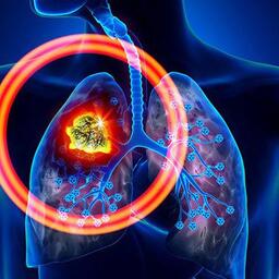 NCT - Nguyên nhân và cách phòng ung thư phổi