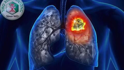 Ung thư phổi có nguy cơ truyền nhiễm?