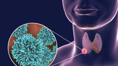 SKCĐ - Phát hiện ung thư tuyến giáp theo chẩn đoán nam y