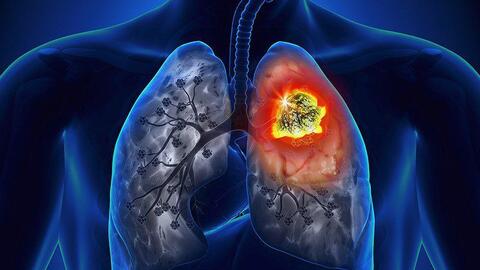 SKCĐ - Đông y hỗ trợ điều trị ung thư phổi