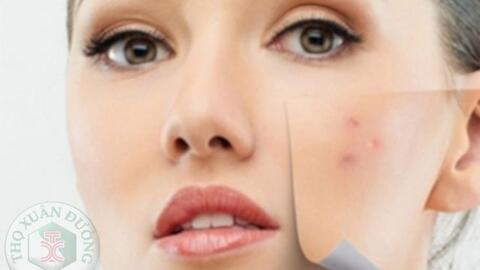 Bật mí mặt nạ trị mụn hiệu quả cho làn da