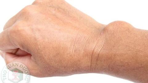 U bao hoạt dịch cổ tay có nguy hiểm không?