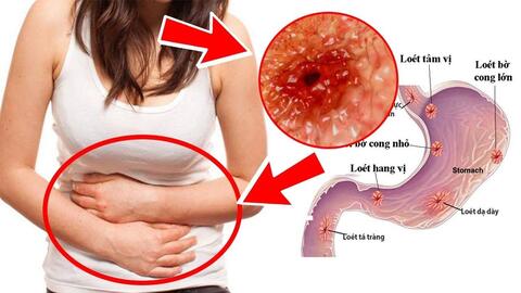 Viêm loét dạ dày có thể gây biến chứng nguy hiểm nào?