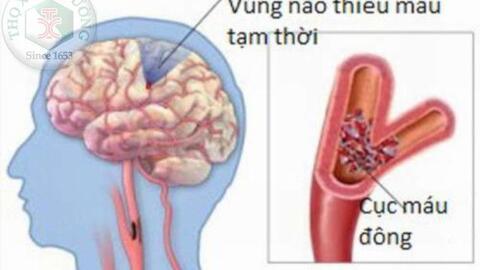Điều trị thiểu năng tuần hoàn não theo đông y