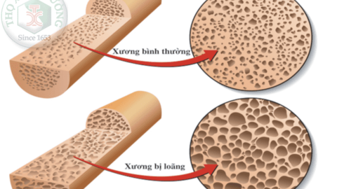 Các phương pháp chẩn đoán loãng xương