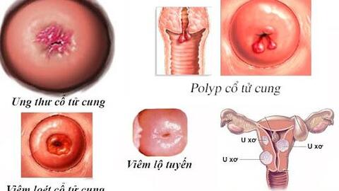 Polyp cổ tử cung là gì, nguyên nhân gây bệnh do đâu?