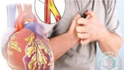 Yếu tố nguy cơ gây bệnh mạch vành