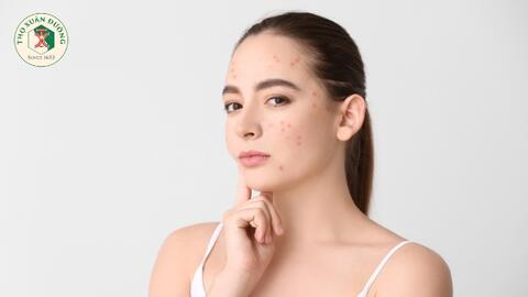 Lý do phát sinh mụn trứng cá