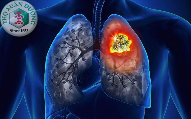 Ung thư phổi trong đông y